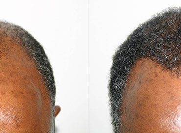 Greffe de Cheveux Afro