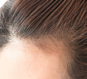 La Greffe De Cheveux Chez Les Femmes